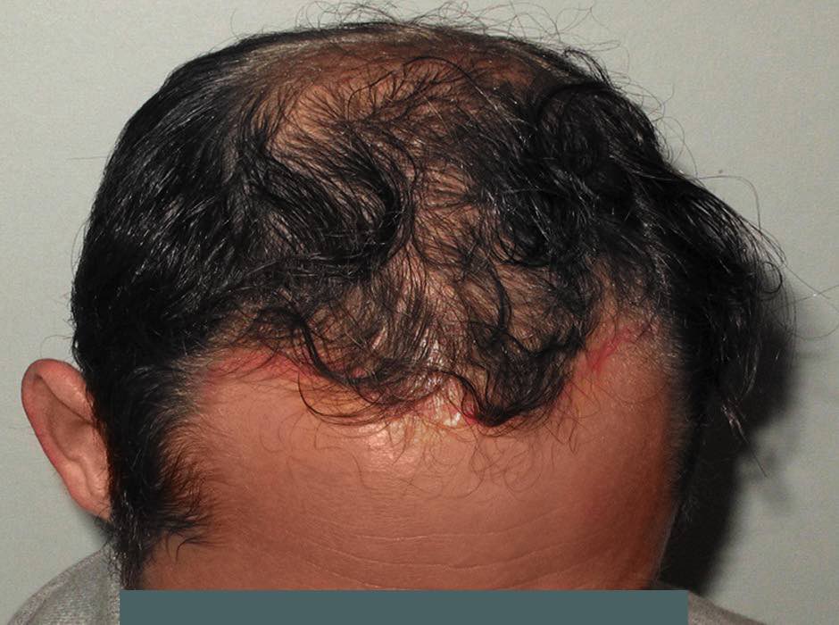 patient-hairloss-a01