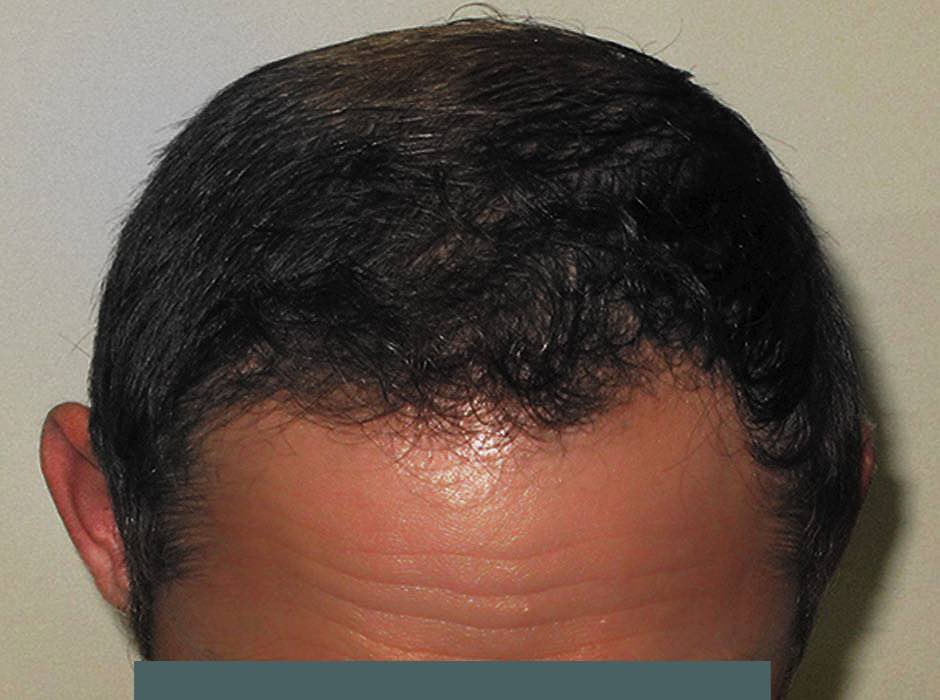 patient-hairloss-a02