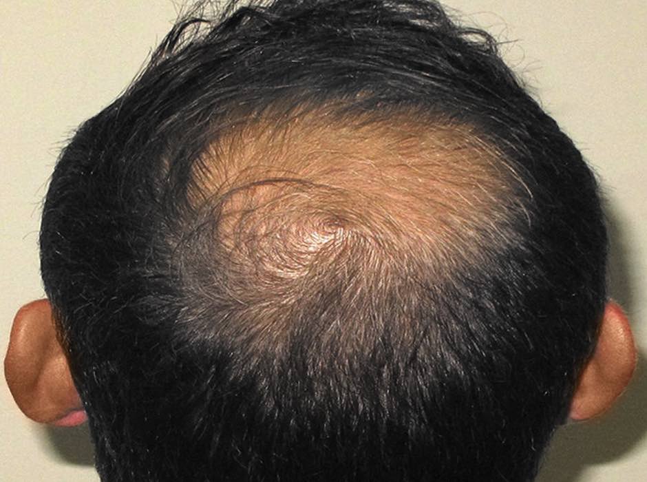 patient-hairloss-a04