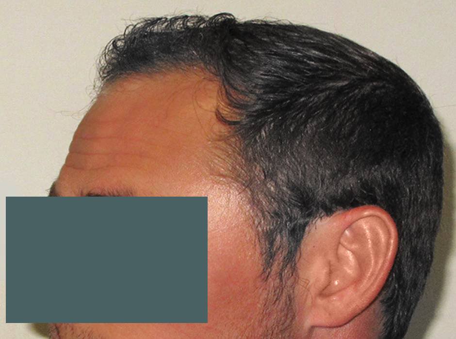 patient-hairloss-a06