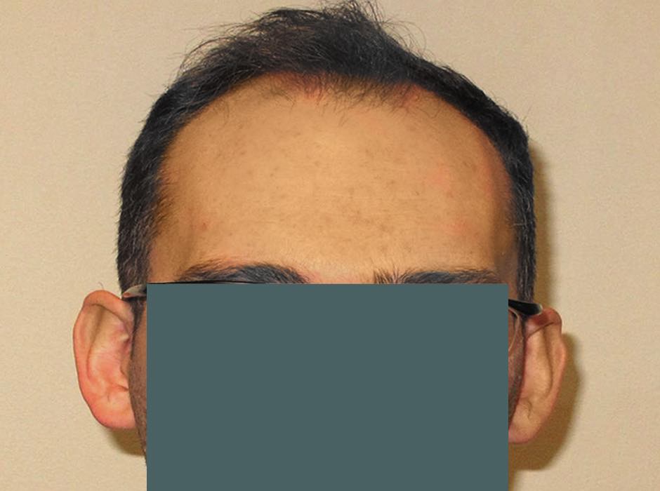 patient-hairloss-b01