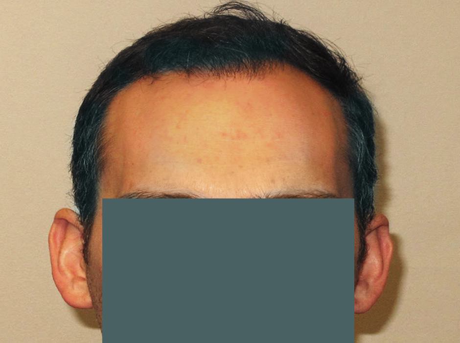 patient-hairloss-b02