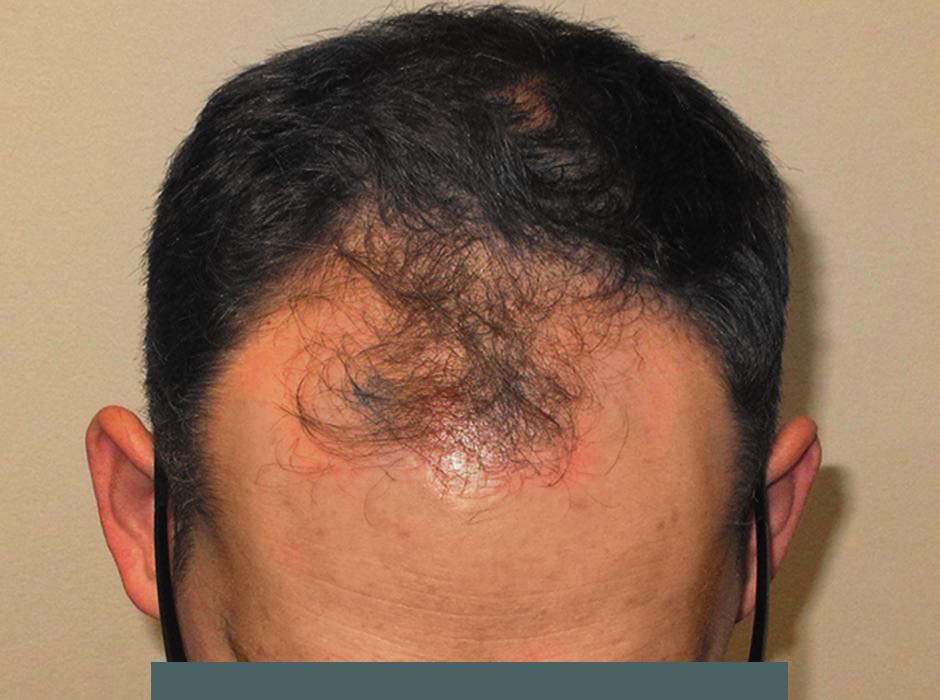 patient-hairloss-b03