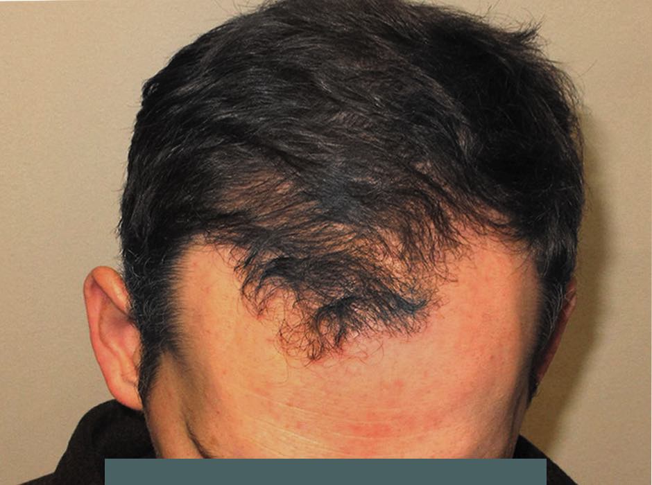 patient-hairloss-b04