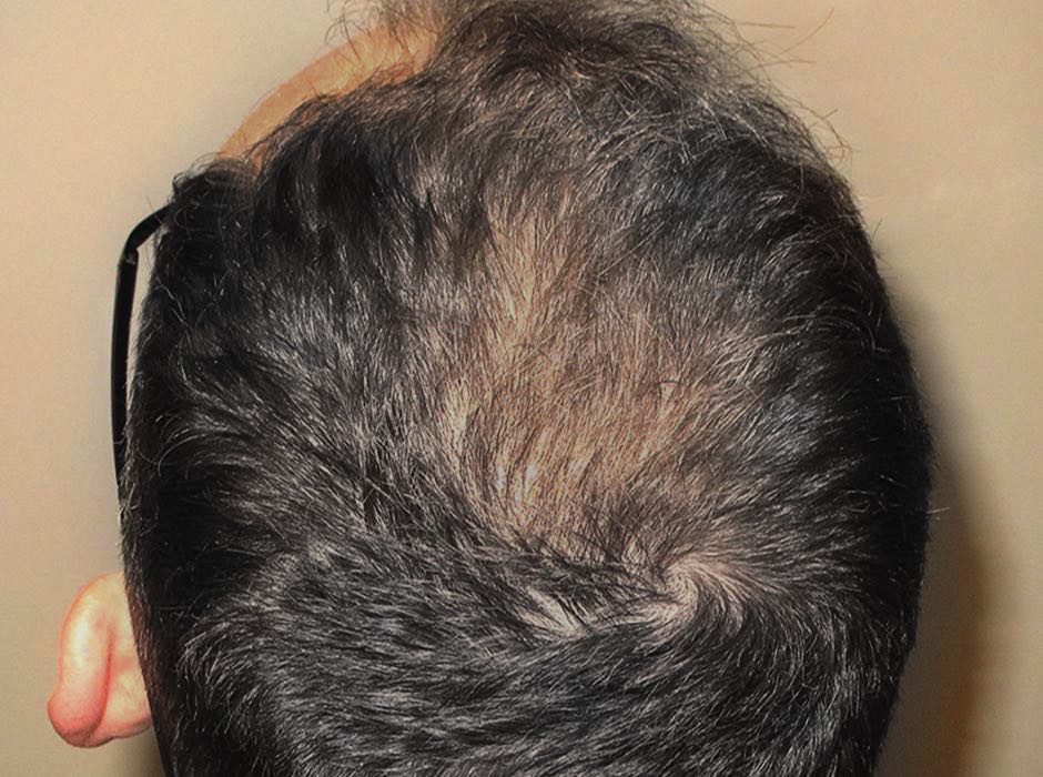 patient-hairloss-b05