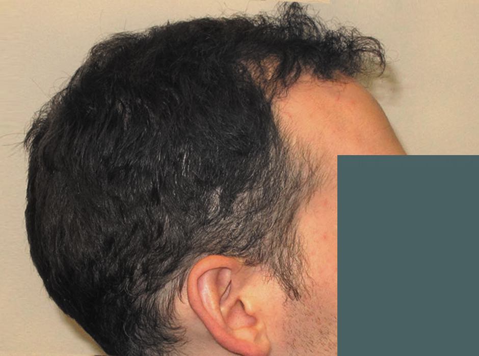 patient-hairloss-b08