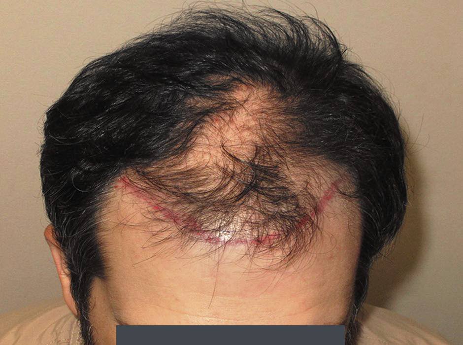 patient-hairloss-c01