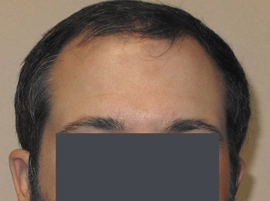patient-hairloss-c03