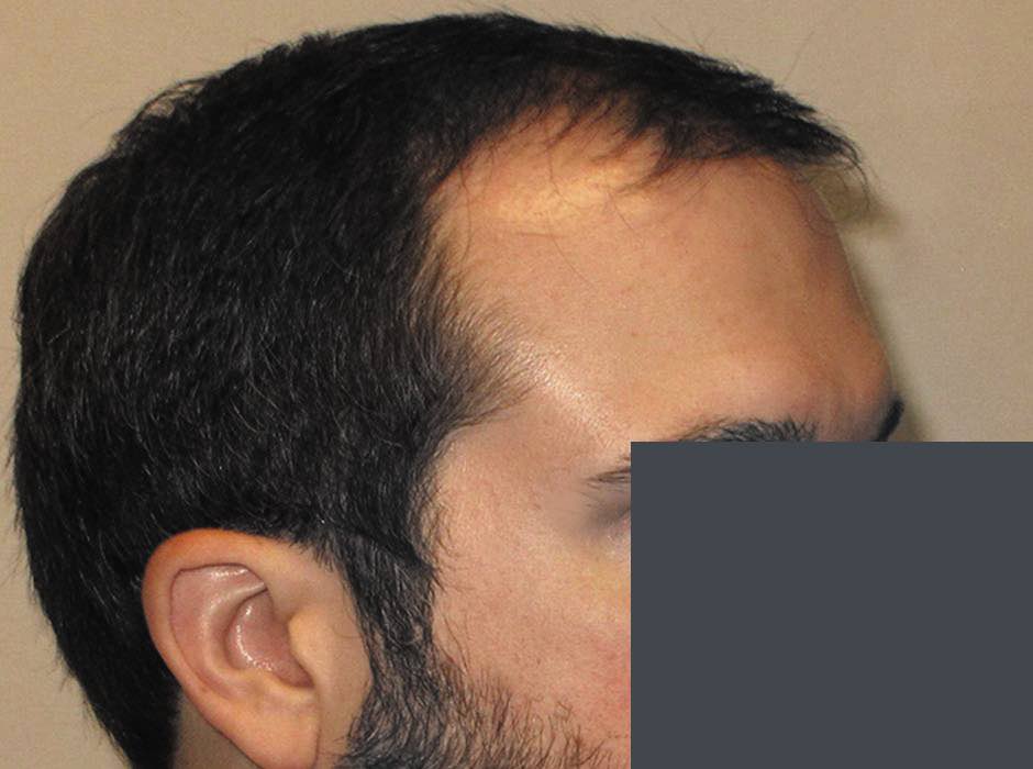 patient-hairloss-c05