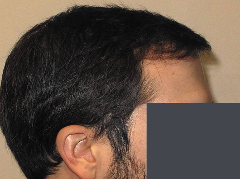 patient-hairloss-c06