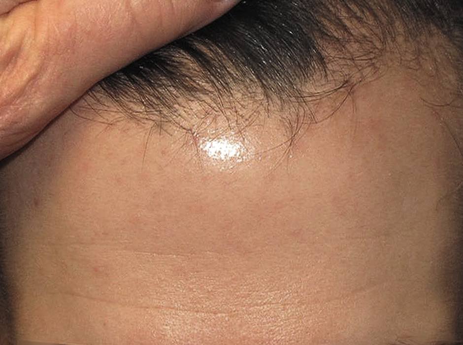 patient-hairloss-c07