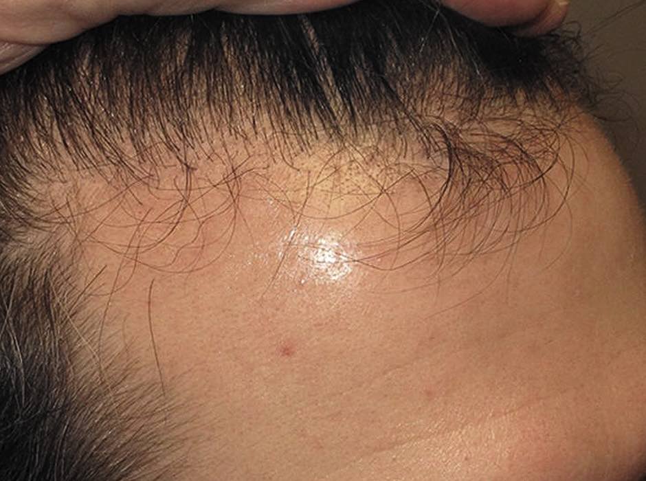 patient-hairloss-c08