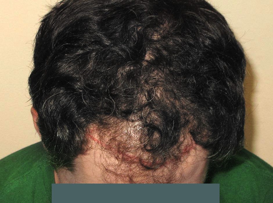 patient-hairloss-d01