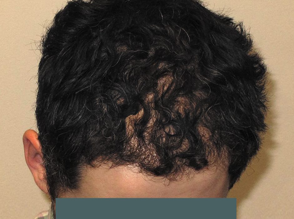 patient-hairloss-d02