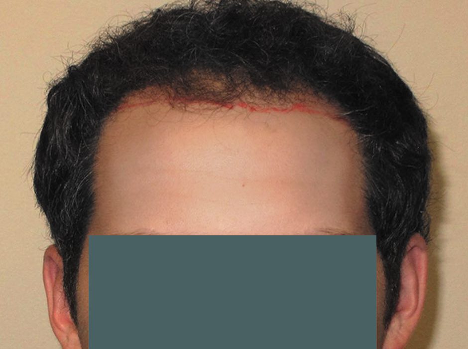 patient-hairloss-d03