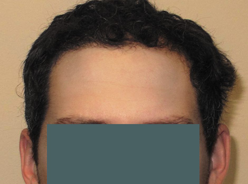 patient-hairloss-d04
